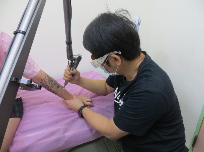 laser tattoo removal activity