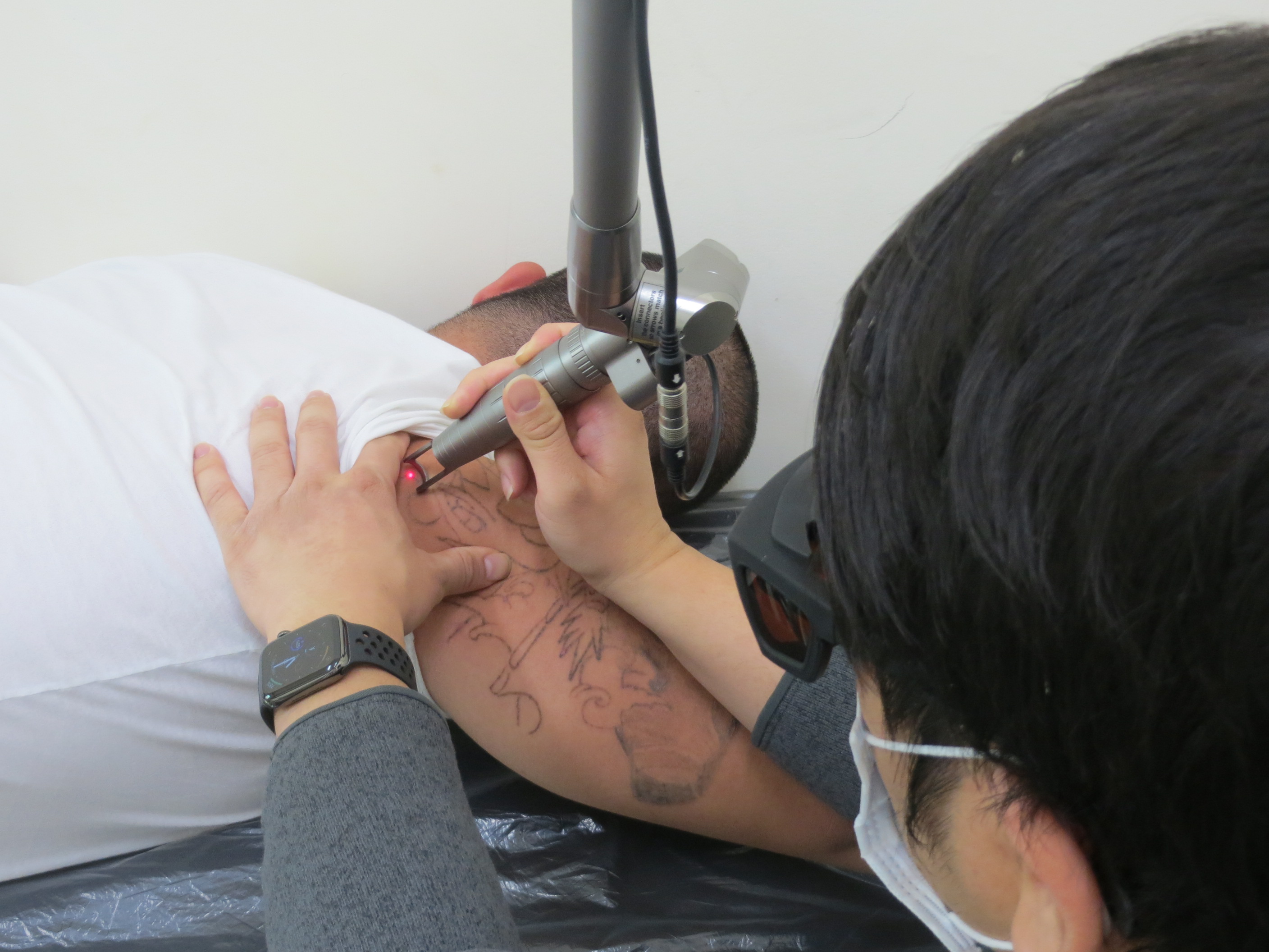 laser tattoo removal activities