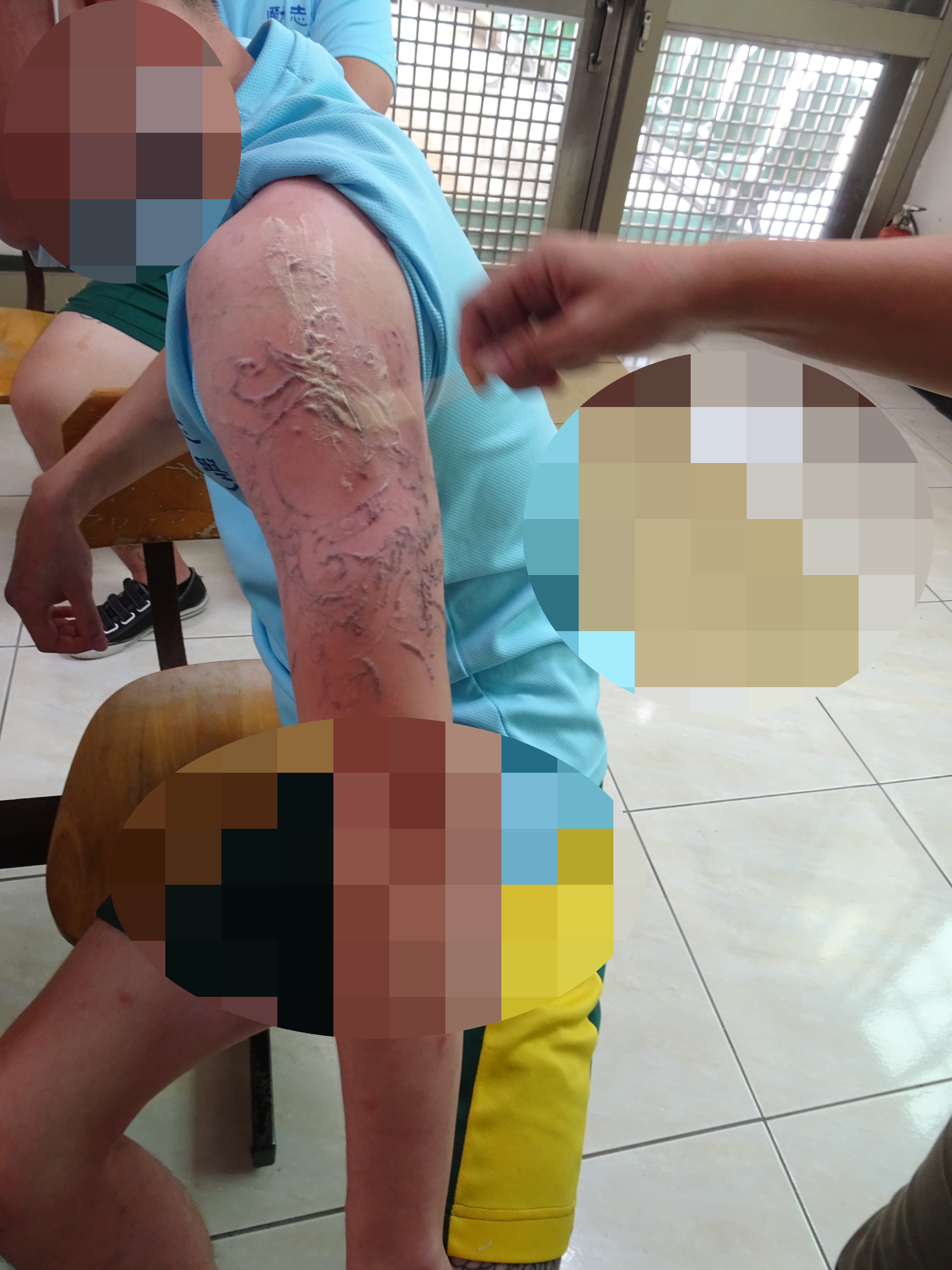 wound care