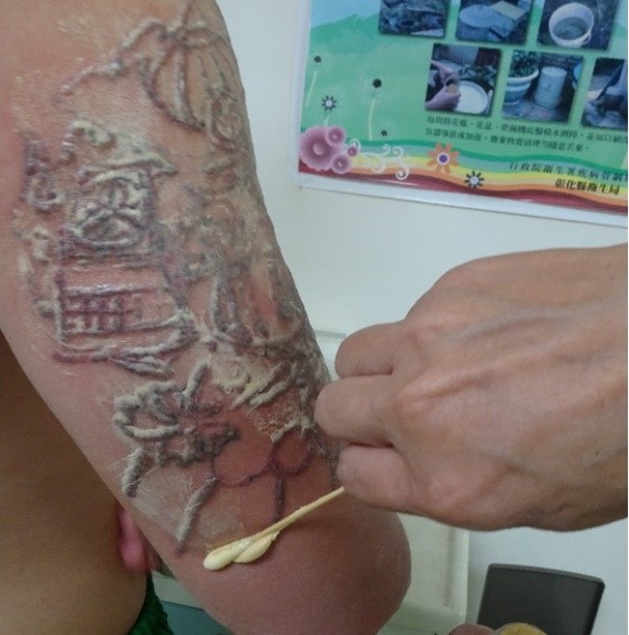 Postoperative totem and wound care
