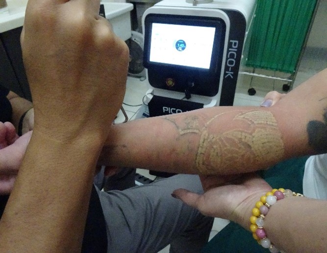 Pico K picosecond laser