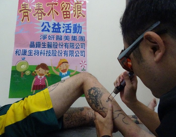 Tattoo removal by doctor
